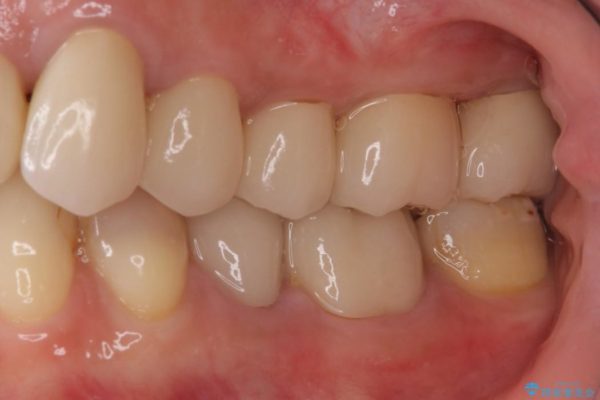 歯肉の奥深くまで進行した虫歯 外科処置による適正な虫歯治療 アフター