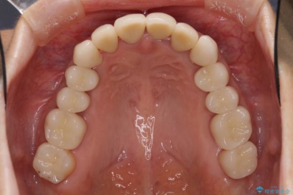 歯肉の奥深くまで進行した虫歯 外科処置による適正な虫歯治療 治療後画像
