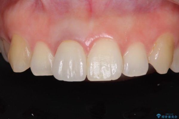 穴が空いて変色した前歯 根管治療とオールセラミッククラウン アフター