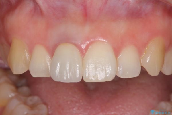 穴が空いて変色した前歯 根管治療とオールセラミッククラウン 治療後画像