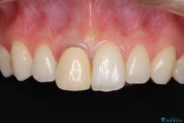 保険診療の前歯が変色してしまった オールセラミッククラウンで自然な前歯に 治療前画像