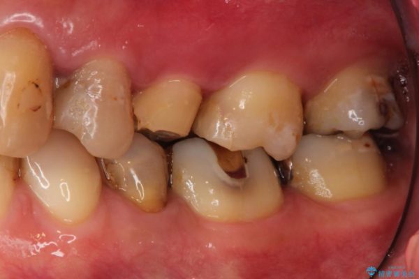 歯肉の奥深くまで進行した虫歯 外科処置による適正な虫歯治療 ビフォー
