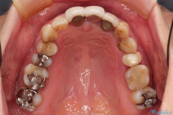 歯肉の奥深くまで進行した虫歯 外科処置による適正な虫歯治療 治療前画像
