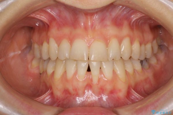 下顎前歯の歯肉退縮 歯肉移植による根面被覆 治療前画像