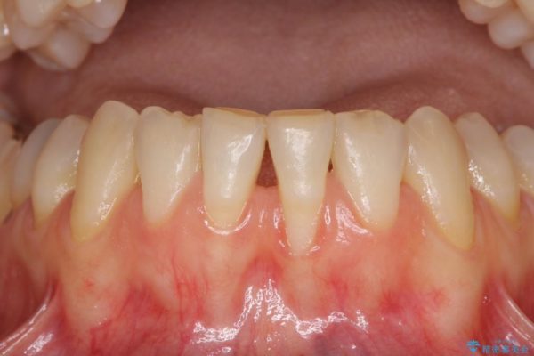 下顎前歯の歯肉退縮 歯肉移植による根面被覆 治療前画像