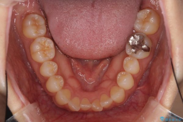 前歯の歯並びと小さい歯を改善　インビザラインとオールセラミッククラウン 治療前画像