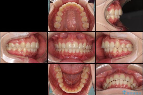 前歯の出っ歯とでこぼこ　目立たないワイヤー装置で抜歯矯正 治療後画像