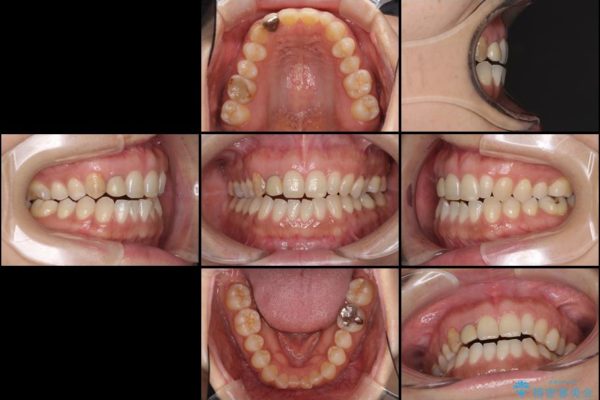 前歯の歯並びと小さい歯を改善　インビザライン矯正とオールセラミッククラウン 治療前画像