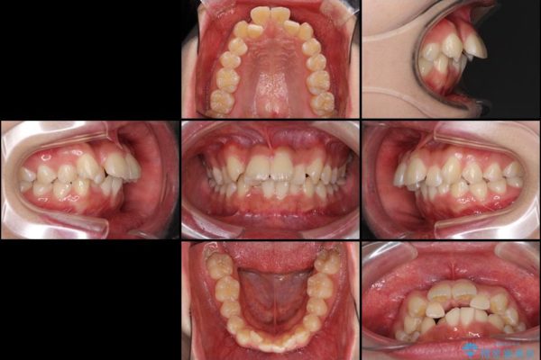 前歯の出っ歯とでこぼこ　目立たないワイヤー装置で抜歯矯正 治療前画像