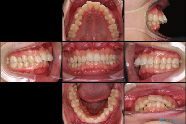 気になる出っ歯をマウスピースで改善　インビザラインによる矯正治療 治療前画像