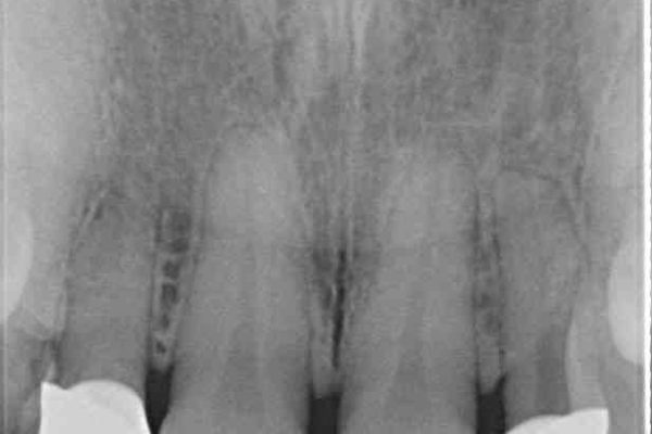 前歯の歯並びと小さい歯を改善　インビザライン矯正とオールセラミッククラウン 治療前画像