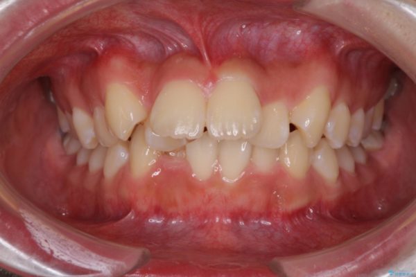 前歯の出っ歯とでこぼこ　目立たないワイヤー装置で抜歯矯正 ビフォー