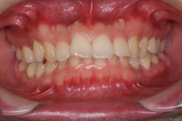 気になる出っ歯をマウスピースで改善　インビザラインによる矯正治療 治療前画像