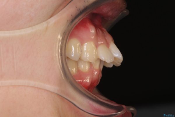 気になる出っ歯をマウスピースで改善　インビザラインによる矯正治療 ビフォー