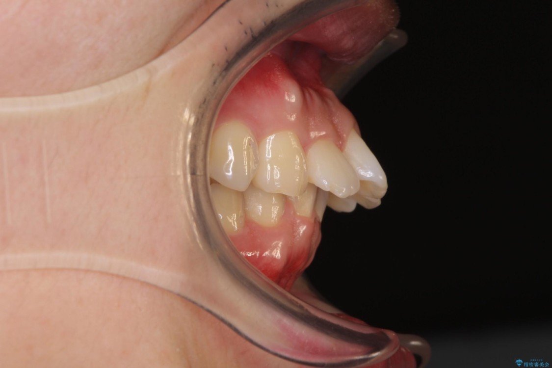 気になる出っ歯をマウスピースで改善　インビザラインによる矯正治療 治療前
