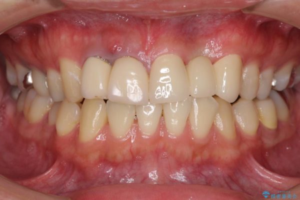 急いで前歯を治したい　抜歯とセラミックブリッジ 治療後画像