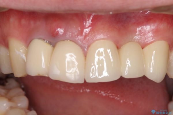 急いで前歯を治したい　抜歯とセラミックブリッジ 治療後画像