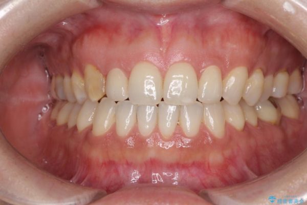前歯の歯並びと小さい歯を改善　インビザライン矯正とオールセラミッククラウン アフター