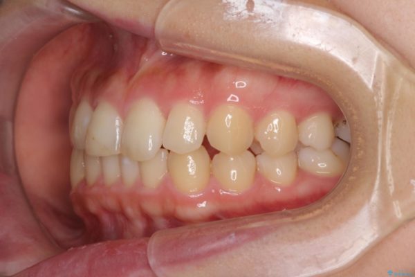 前歯のすきっぱを治したい　マウスピース(ASOアライナー)による矯正治療 治療後画像