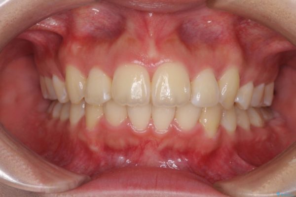 前歯の出っ歯とでこぼこ　目立たないワイヤー装置で抜歯矯正 アフター