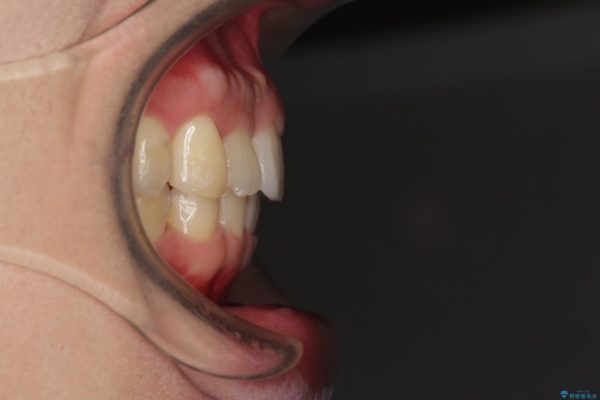 気になる出っ歯をマウスピースで改善　インビザラインによる矯正治療 治療後画像
