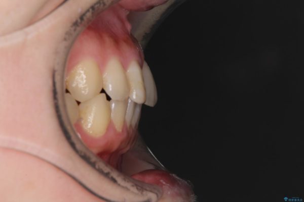前歯のすきっぱを治したい　マウスピース(ASOアライナー)による矯正治療 治療前画像