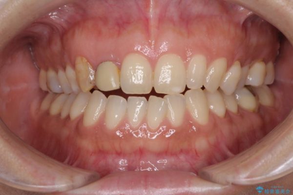 前歯の歯並びと小さい歯を改善　インビザライン矯正とオールセラミッククラウン ビフォー