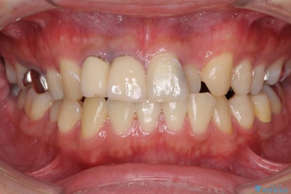 急いで前歯を治したい　抜歯とセラミックブリッジ 治療前画像