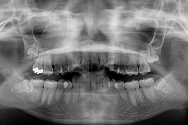 歯並びを気にせず笑いたい　インビザラインによる矯正治療 治療前画像
