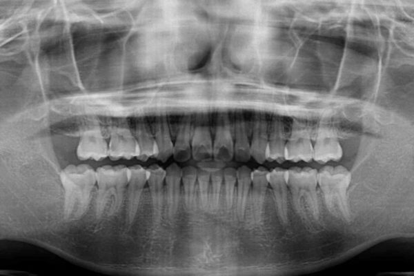 前歯の出っ歯とでこぼこ　目立たないワイヤー装置で抜歯矯正 治療後画像
