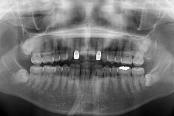 前歯の歯並びと小さい歯を改善　インビザライン矯正とオールセラミッククラウン 治療後画像
