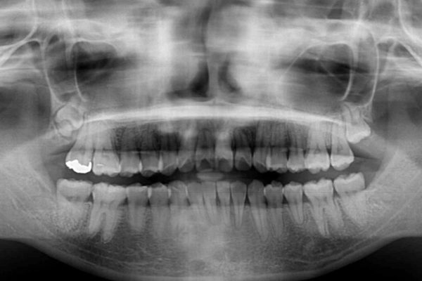 歯並びを気にせず笑いたい　インビザラインによる矯正治療 治療後画像