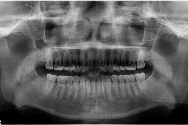 気になる出っ歯をマウスピースで改善　インビザラインによる矯正治療 治療後画像