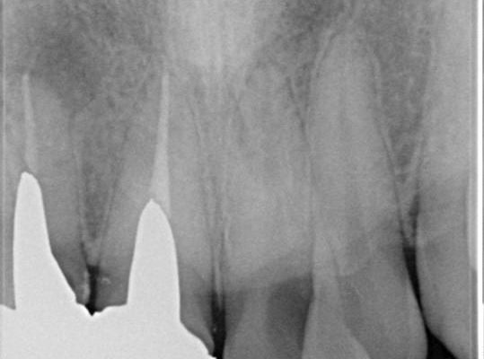 急いで前歯を治したい　抜歯とセラミックブリッジ 治療前画像