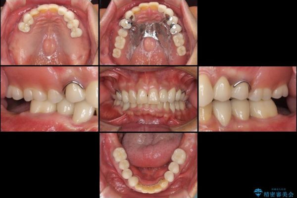 奥歯で物を噛めるようにしたい 入れ歯による咬合回復 治療後画像