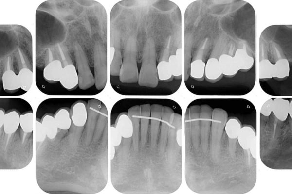 奥歯で物を噛めるようにしたい 入れ歯による咬合回復 治療後画像