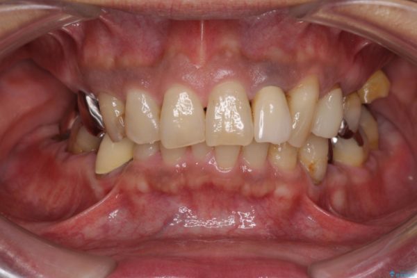奥歯で物を噛めるようにしたい 入れ歯による咬合回復 治療前画像
