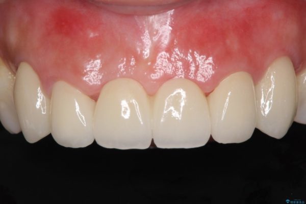 前歯のブリッジを綺麗に作り変えたい 治療後画像
