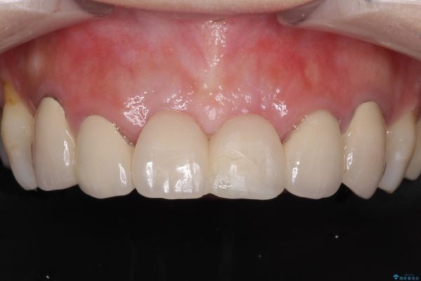前歯のブリッジを綺麗に作り変えたい 治療前画像