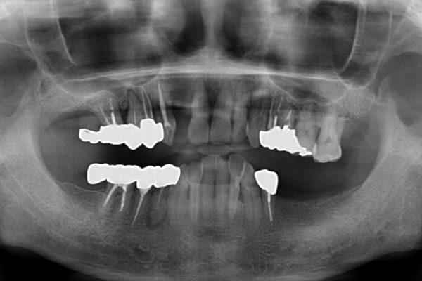 ボロボロの歯を何とかしたい　総合歯科治療による全顎治療 治療前画像