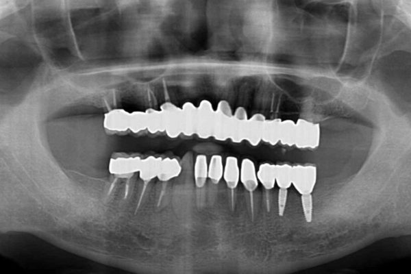 ボロボロの歯を何とかしたい　総合歯科治療による全顎治療 治療後画像