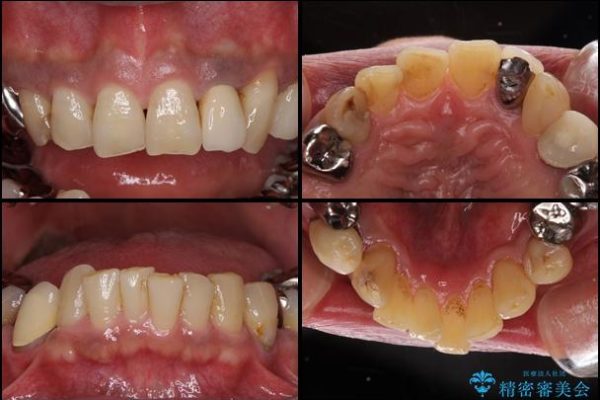奥歯で物を噛めるようにしたい 入れ歯による咬合回復 治療前画像