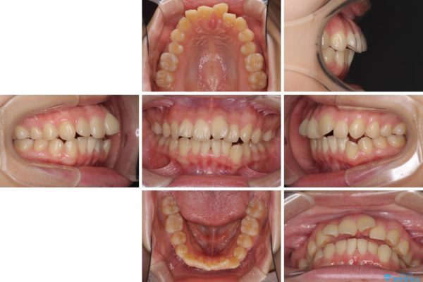 デコボコで飛び出した前歯をきれいに　インビザラインによる矯正治療 治療前画像