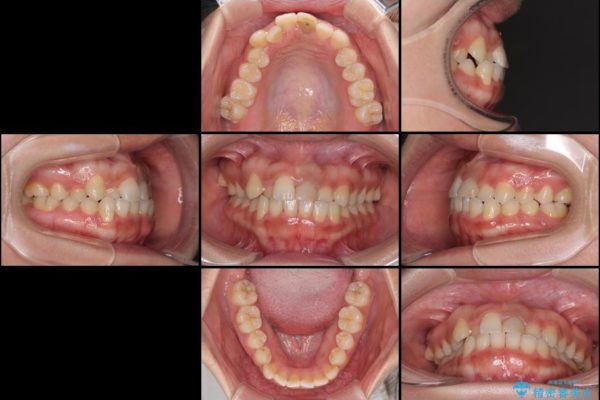 前歯の反対咬合　非抜歯のワイヤー矯正 治療前画像