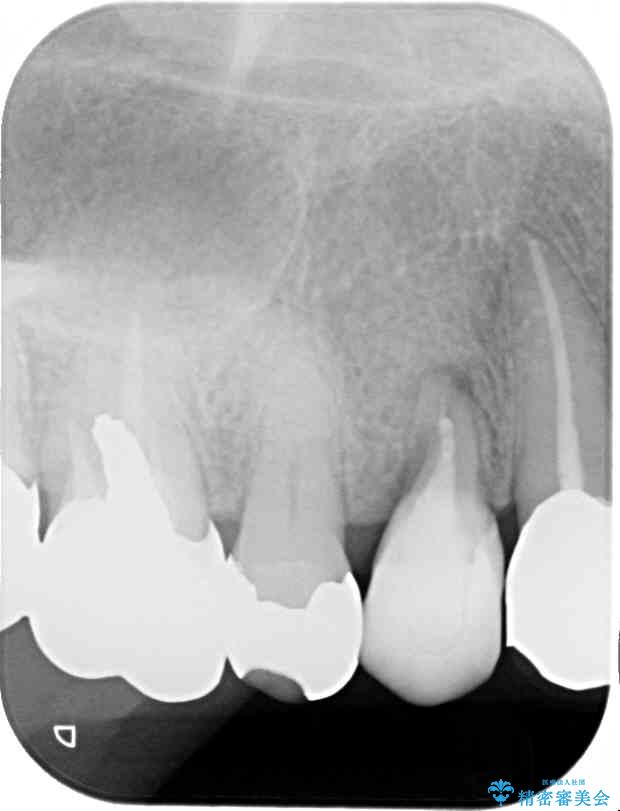 小臼歯の審美治療　ストローマンインプラントとカスタムアバットメント 治療前
