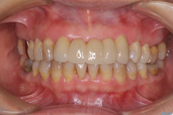 古くなった前歯のブリッジをオールセラミックに 治療後画像