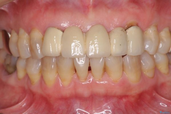 古くなった前歯のブリッジをオールセラミックに 治療前画像