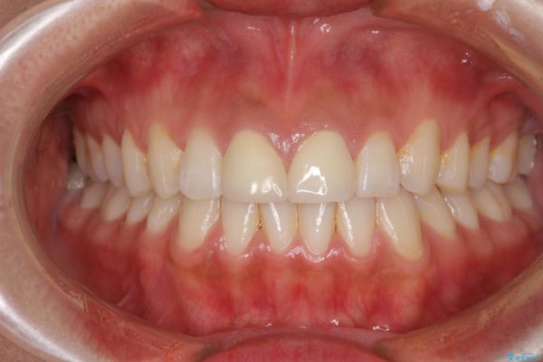 気になる前歯の隙間をオールセラミックで閉じる 治療後画像