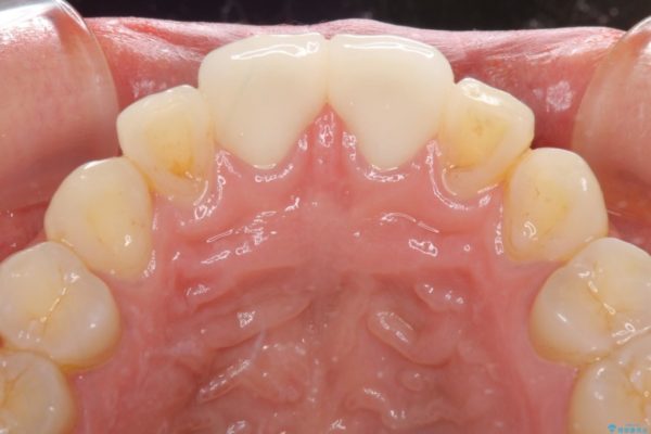 気になる前歯の隙間をオールセラミックで閉じる 治療後画像