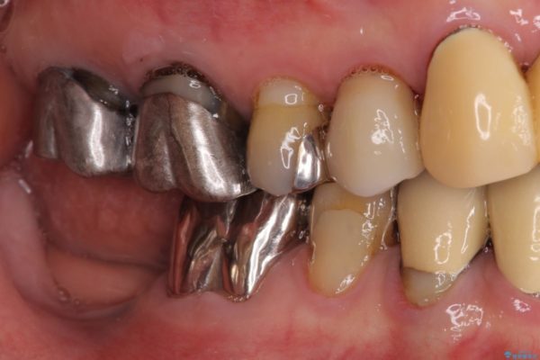 小臼歯の審美治療　ストローマンインプラントとカスタムアバットメント 治療前画像